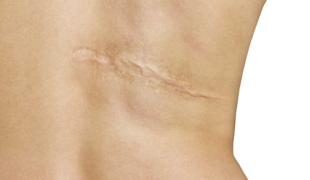Cicatrices queloides o excesivas