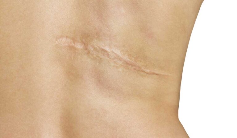 Cómo prevenir las cicatrices excesivas